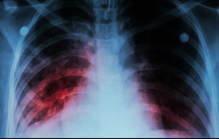 Minsa realiza acciones para el control de tuberculosis en tiempos de pandemia por covid-19