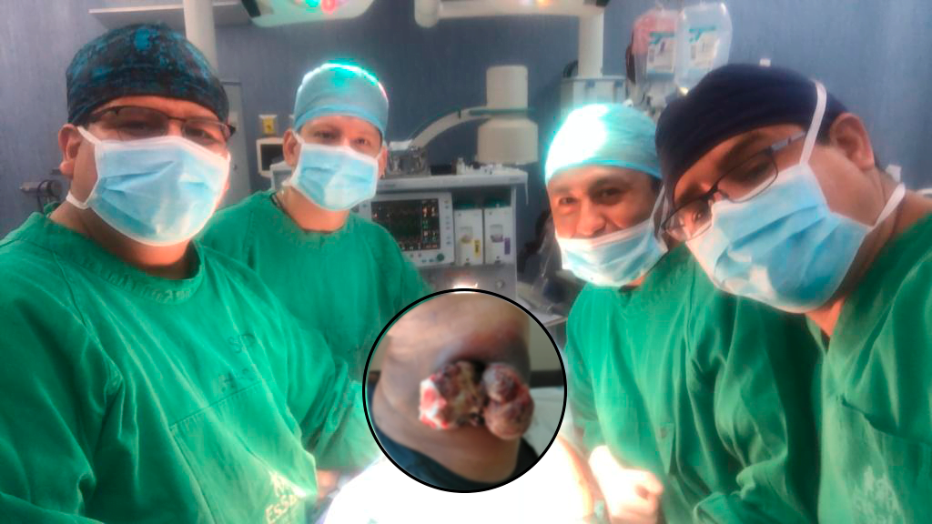 Paciente covid-19 de 76 años fue operado de un tumor maligno en Trujillo