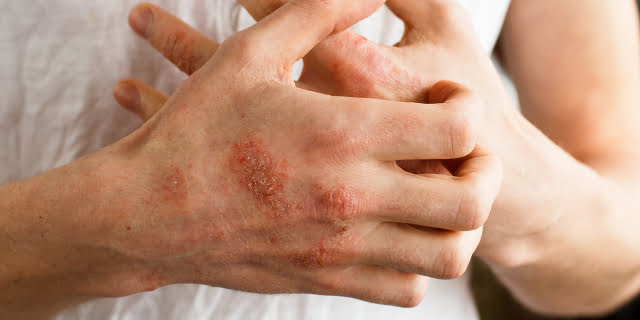 Tipos de Dermatitis por contacto