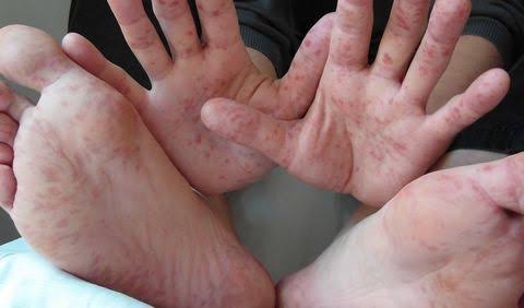 Reportan brote de virus Coxsackie en Pataz