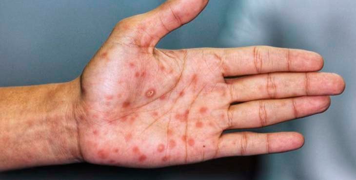 Nuevos caso de viruela del mono se detectan en el país