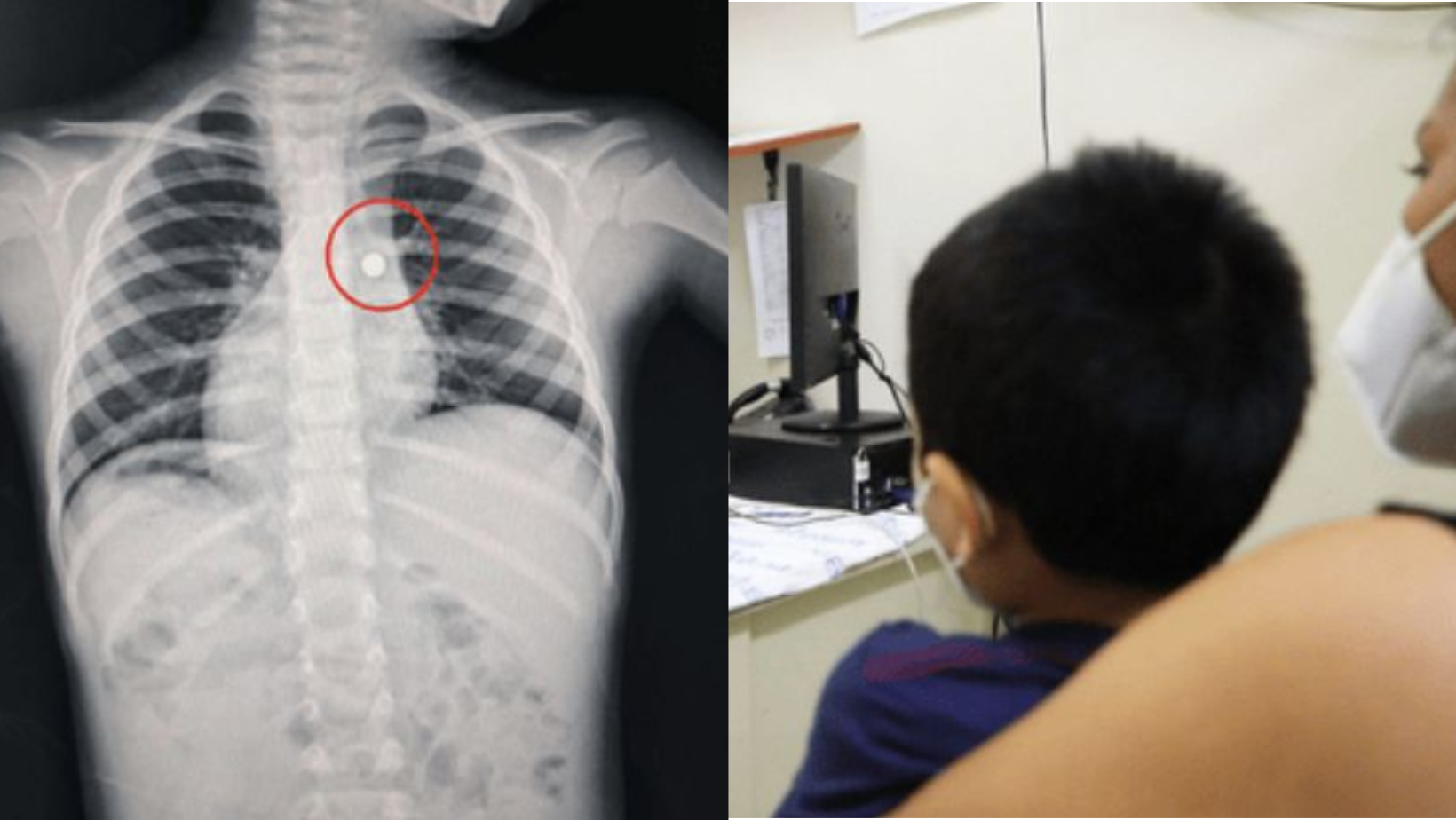 Trujillo: Médicos salvan la vida de niño de 4 años que tenía una pila alojada en un pulmón