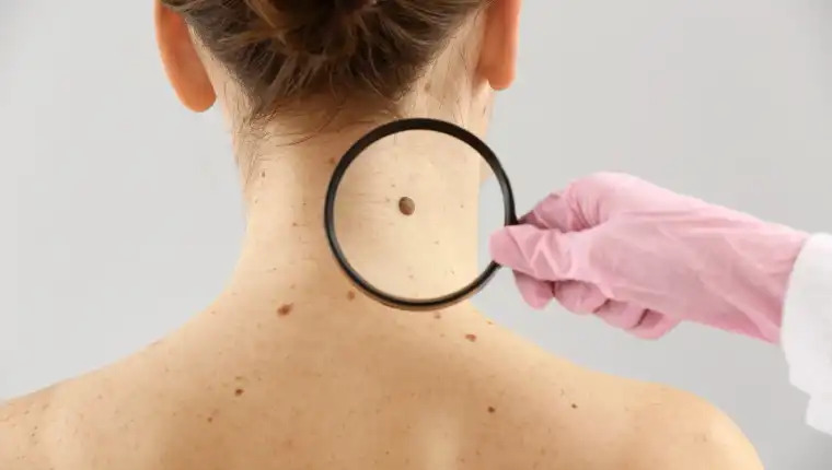 Detección temprana de lunares malignos: una clave para la prevención del cáncer de piel
