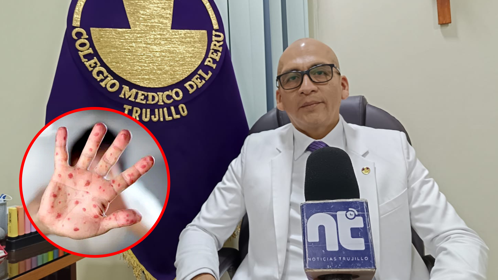 La Libertad: se confirman 5 casos de viruela del mono y 77 en todo el Perú