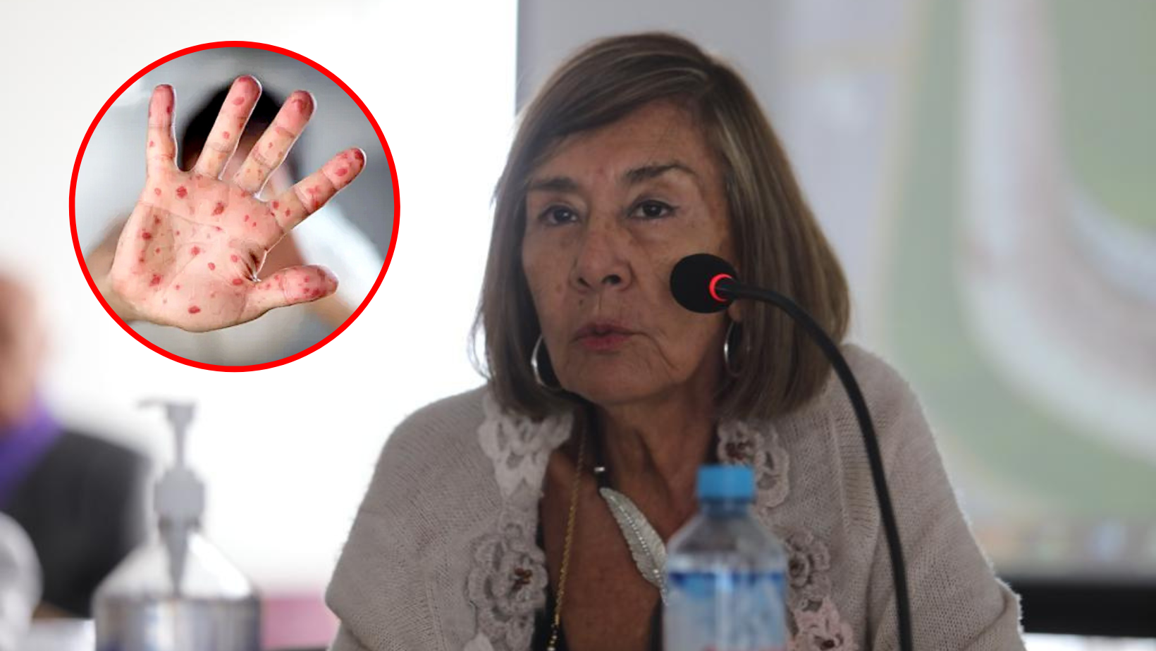 La Libertad: exdecana del Colegio Médico descarta uso de mascarillas por la viruela del mono y niega su letalidad
