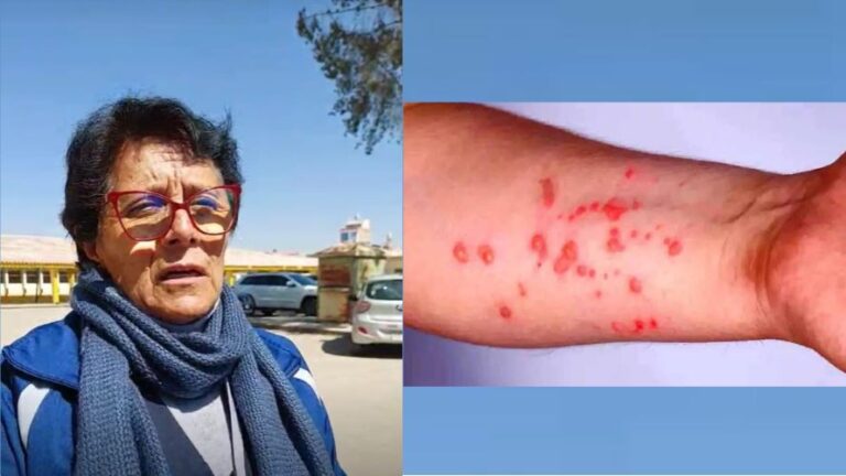 Puno: Segundo caso sospechoso de viruela del mono en Juliaca