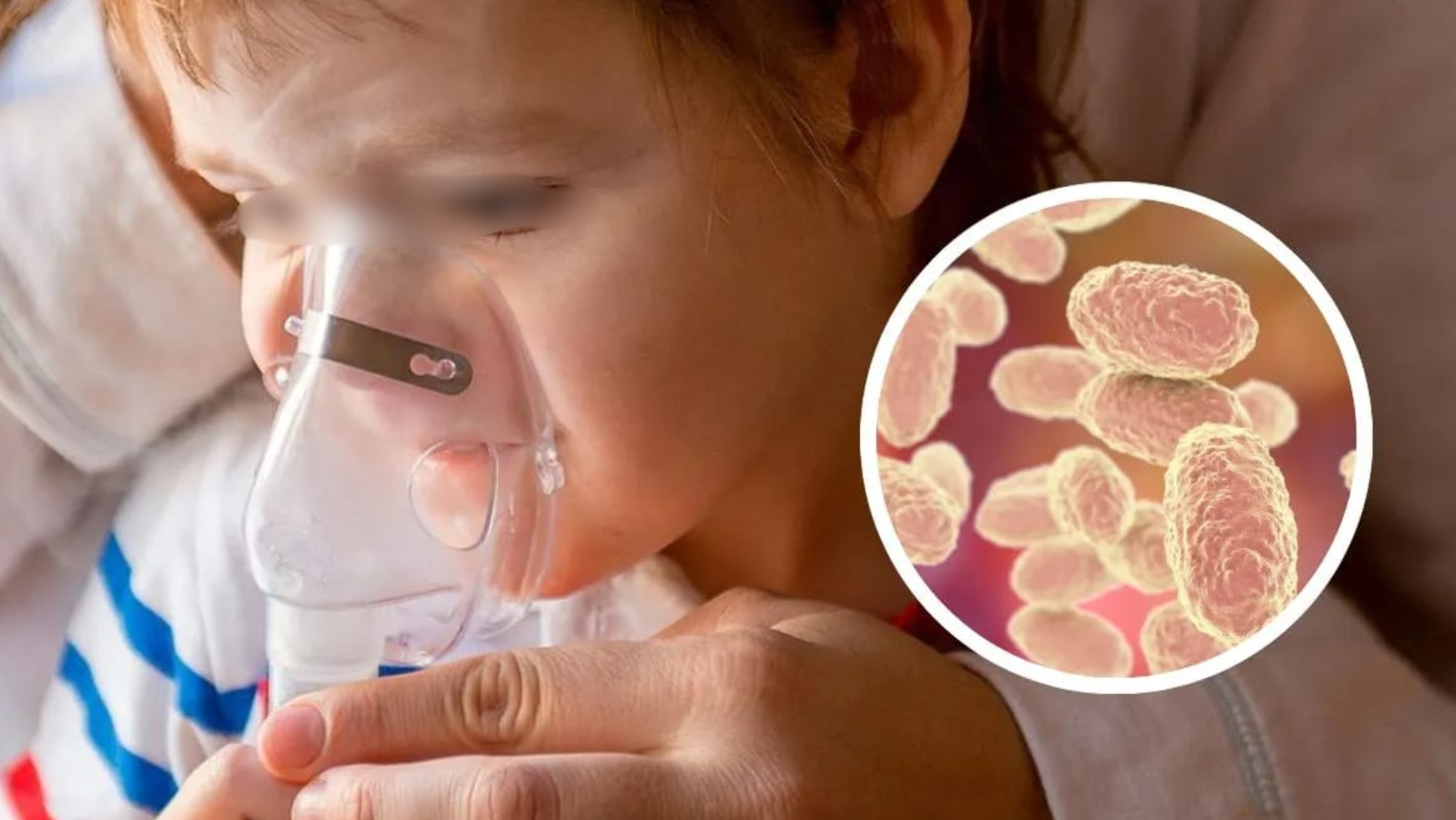 No es una gripe: la tosferina puede causar convulsiones y daños neurológicos en niños