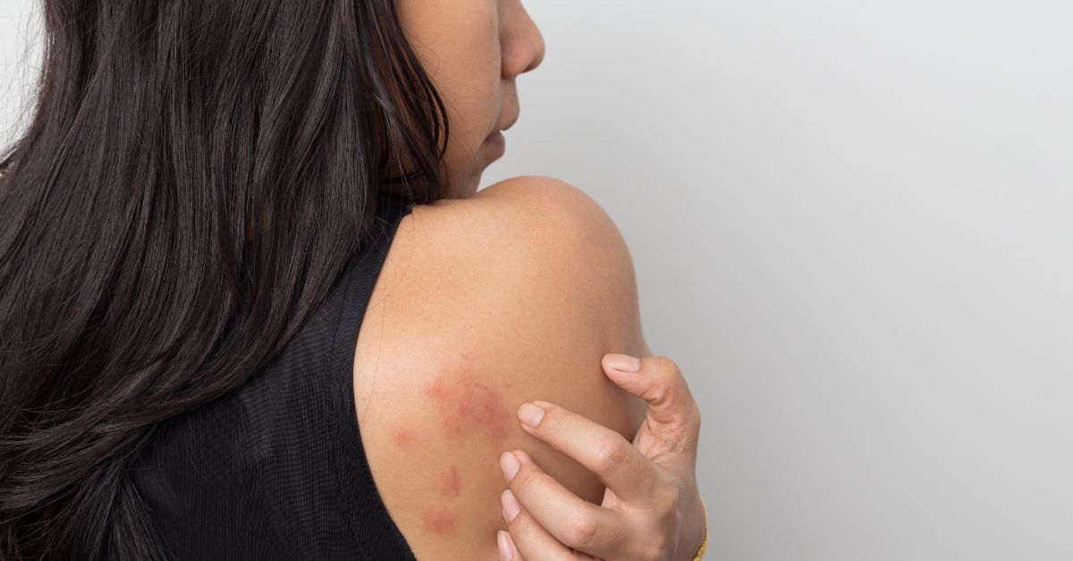 Estrés y ansiedad: dermatólogo advierte aumento de brotes, acné y caída del cabello en pacientes